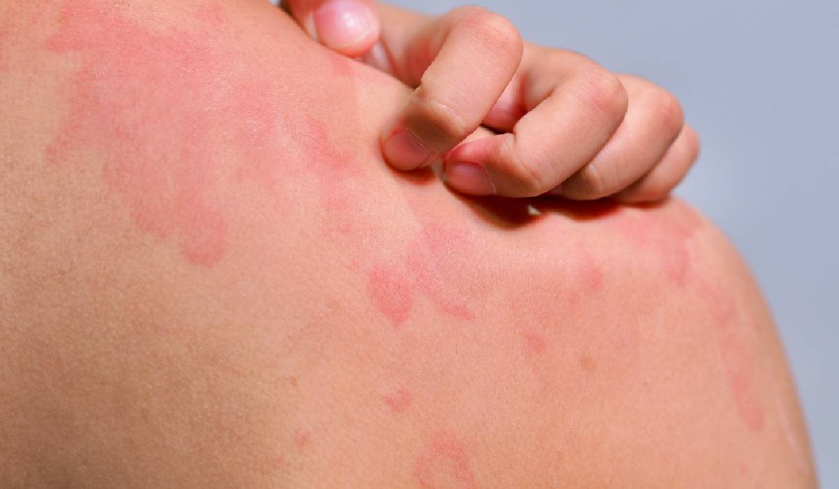 Urticaria cronică spontană: durată, cauze autoimune și când să consulți medicul